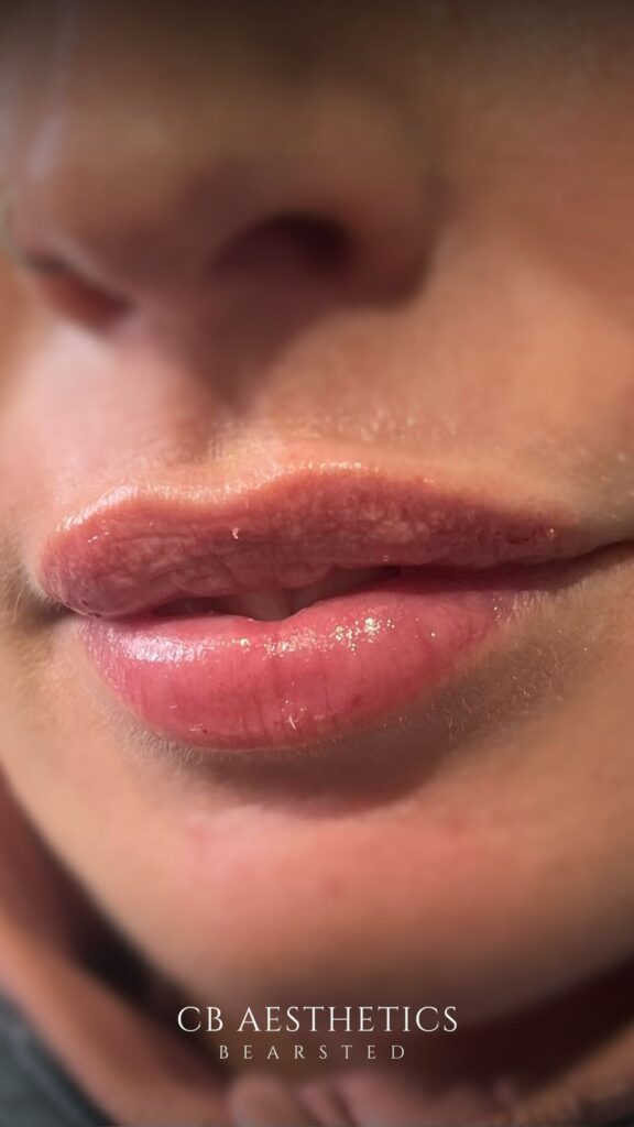Lip Filler